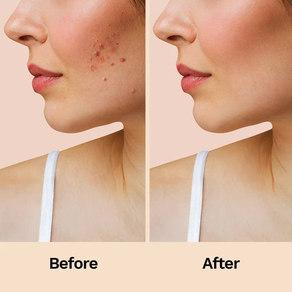 Acne Relief Patches (60 Patches)