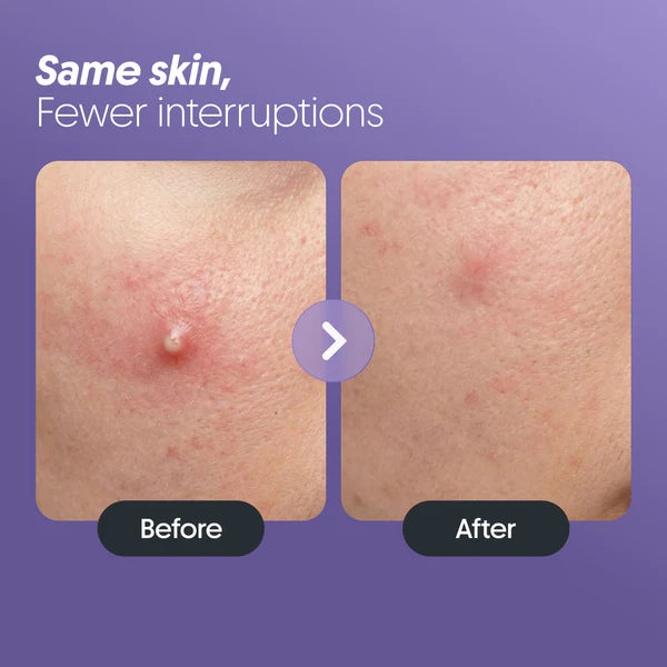 Acne Relief Patches (30 Patches)
