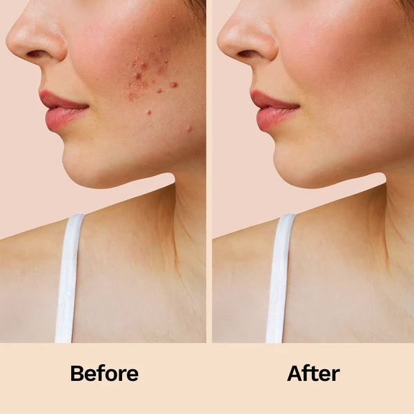 Acne Relief Patches 12N