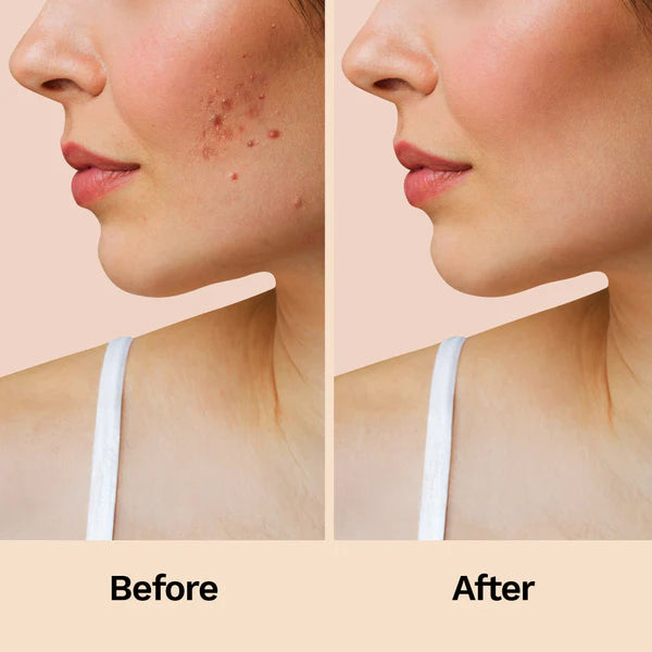Acne Relief Patches (30 Patches)